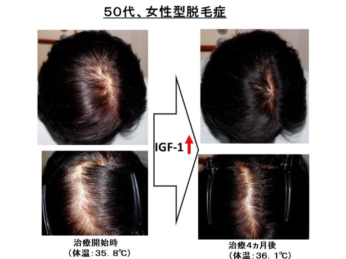 円形脱毛症　病院